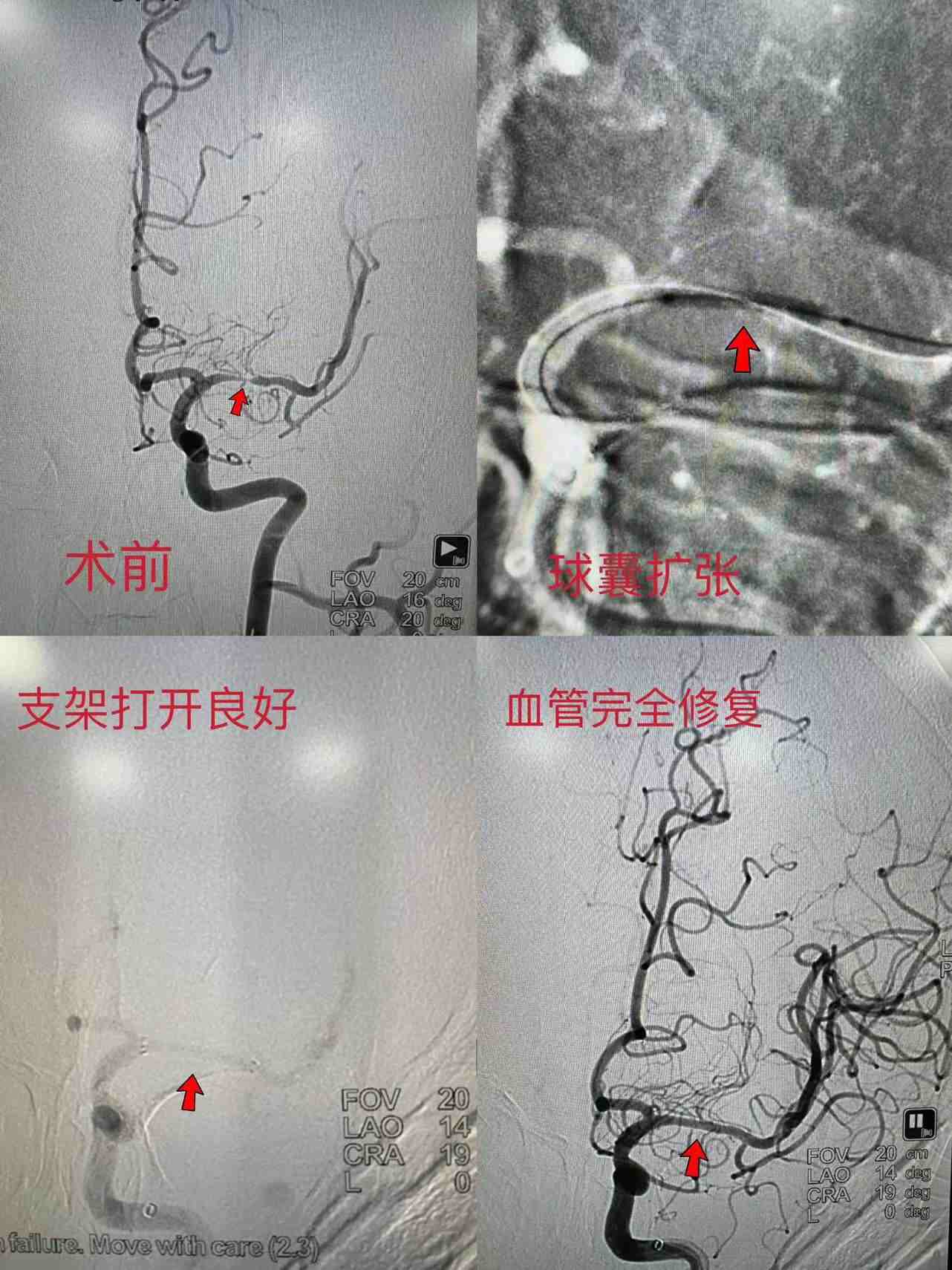 新疆医科大学第七附属医院神经内科开展院内首例左侧大脑中动脉支架植入术