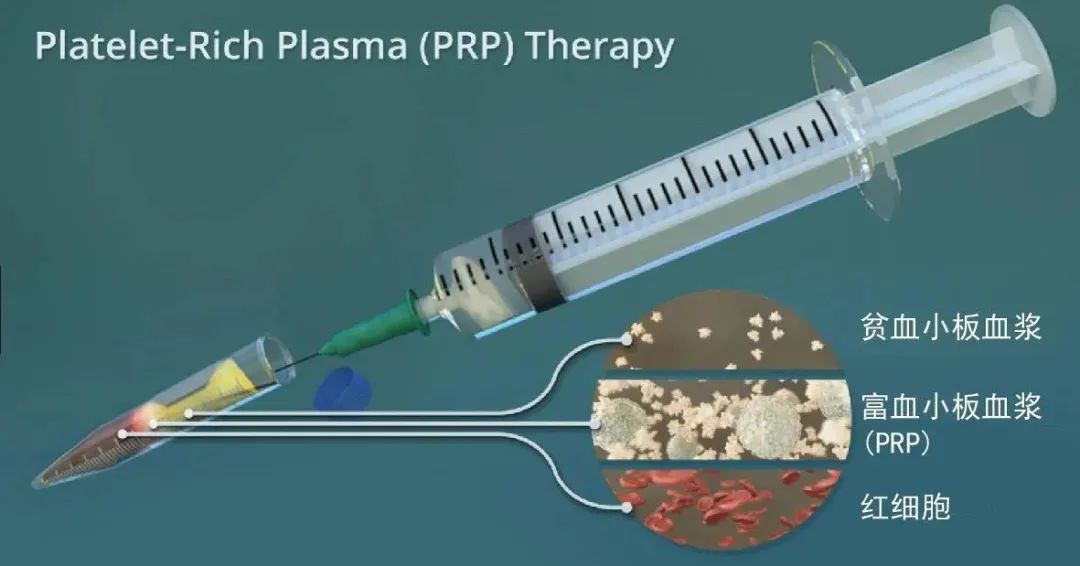 【新技术】骨关节疾病患者的福音！新医大七附院开展PRP（富血小板血浆）治疗